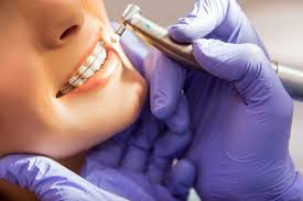 orthodontist Burlington CT