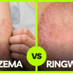 ringworm and eczema