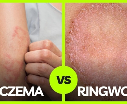 ringworm and eczema