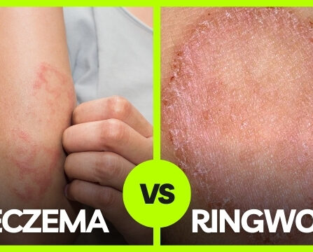 ringworm and eczema