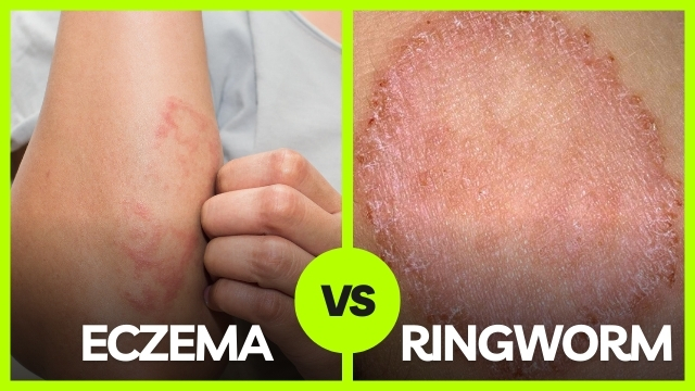 ringworm and eczema