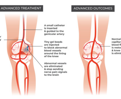 Genicular Artery Embolization