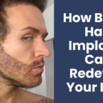 beard hair implant